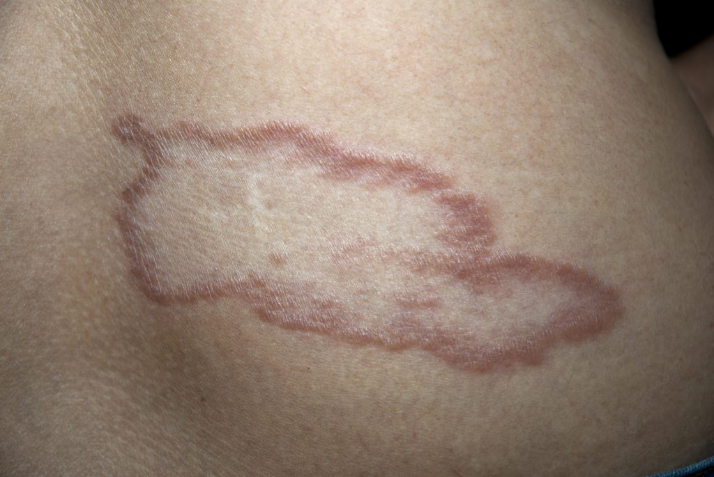 Hanseníase tipo Tuberculoide 