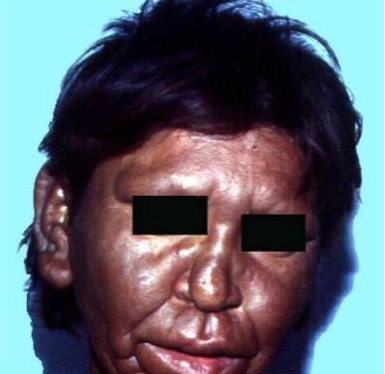 Hanseniase tipo Virchowiana