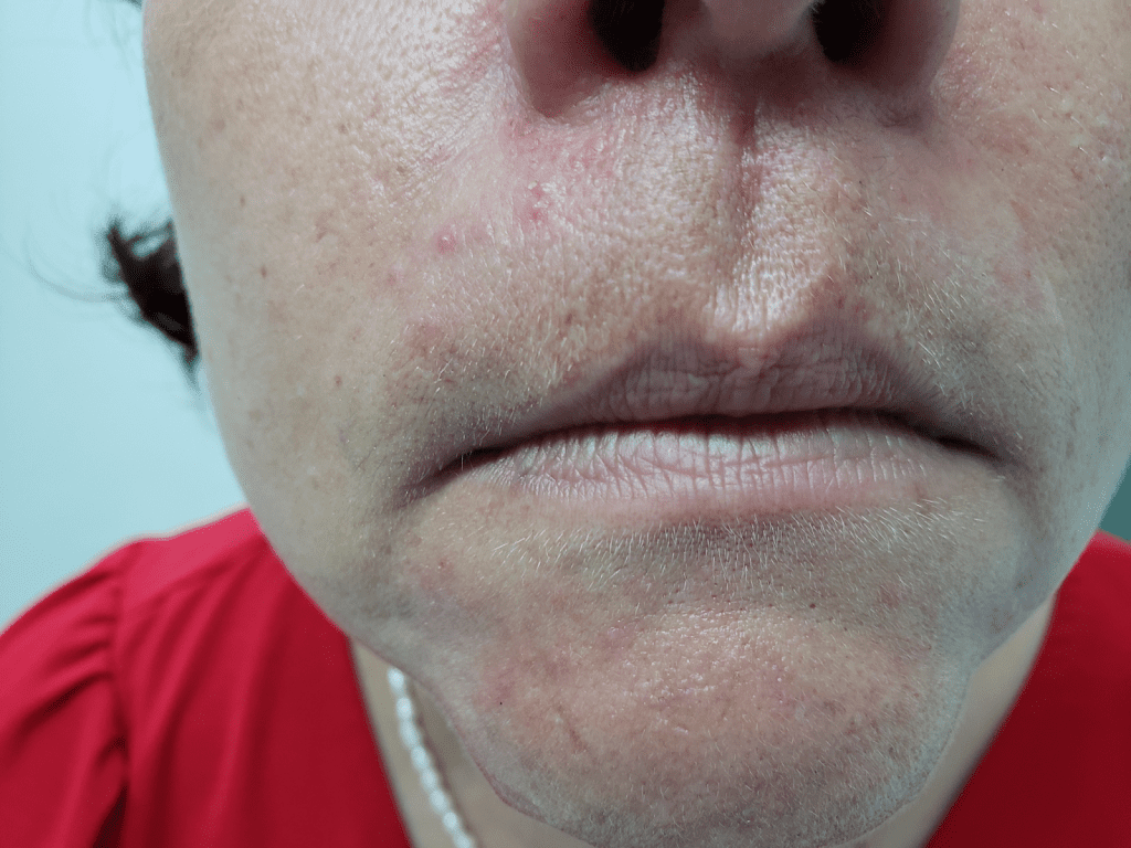 Dermatite Perioral