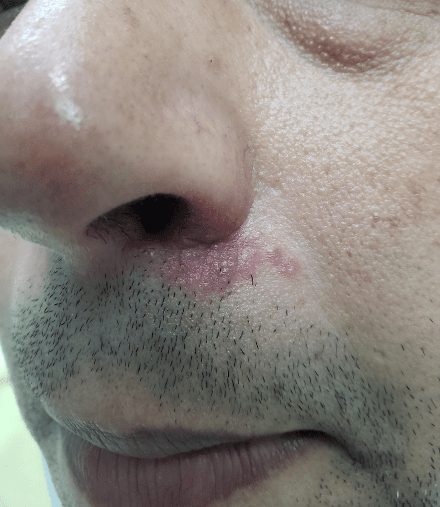 Dermatite Perioral/Periorificial