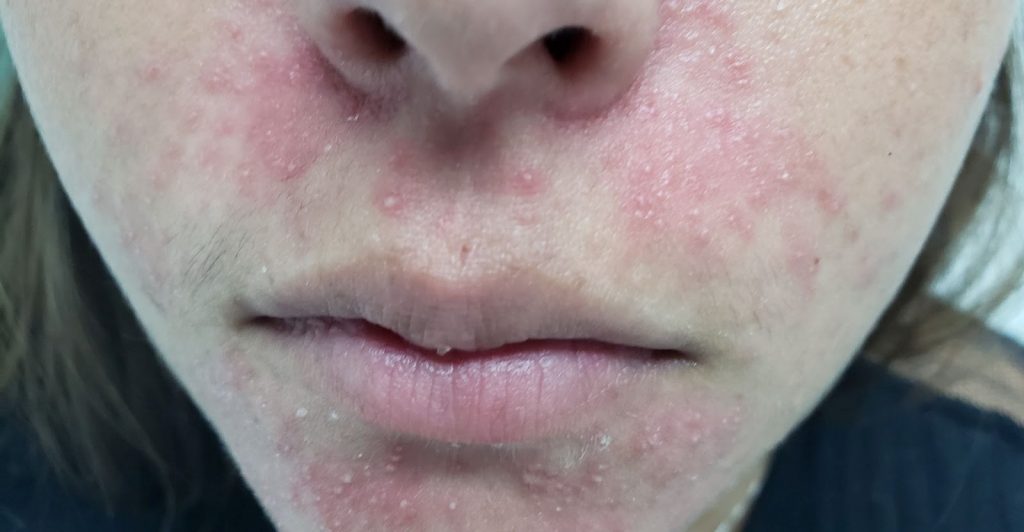 Dermatite Perioral, constituída por vesículas, pústulas e lesões infiltradas avermelhadas ao redor da boca e poupando a pele entre o lábio e o queixo