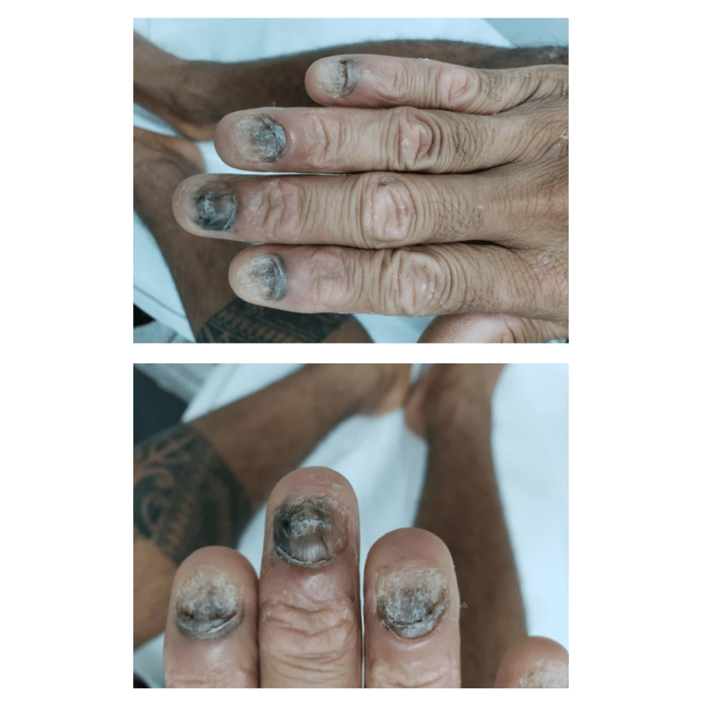 Psoríase ao redor das unhas